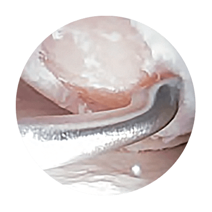 Arthroscopic view of a prepared cartilage defect with a stable shoulder